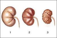 A comprehensive review of chronic kidney disease from the Āyurvedic perspective